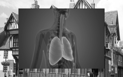 Synairgen announces positive findings from analysis of lung samples from the SG015 trial of SNG001 in virally infected COPD patients